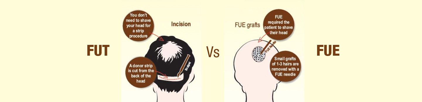 FUE - FUT Hair Transplant Technique comparison