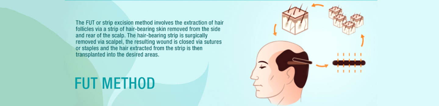 FUT Hair Transplant Ahmedabad Gujarat